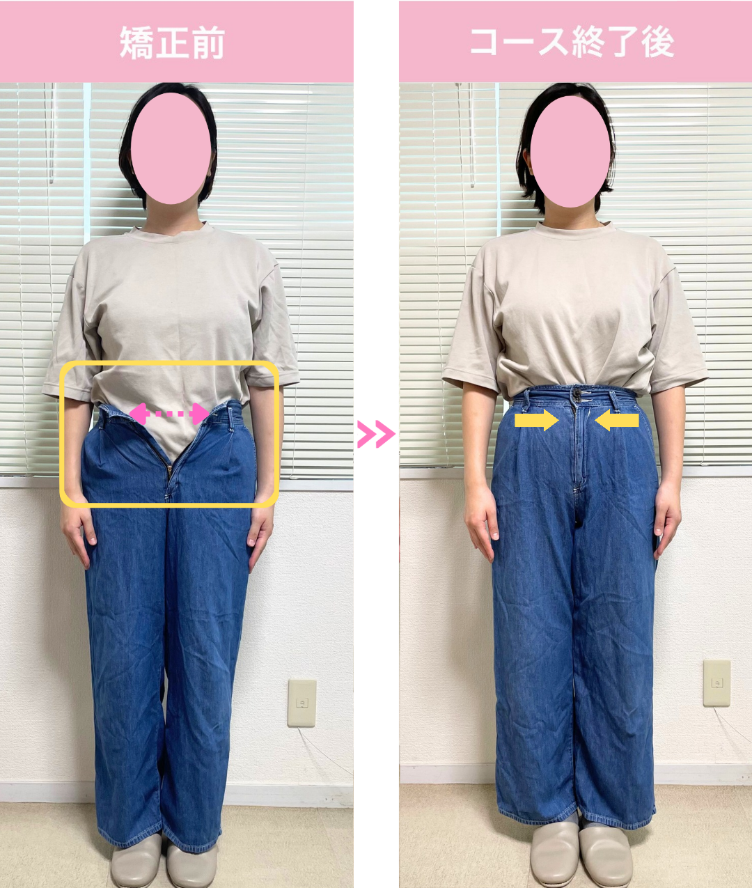 恵比寿クリニーク産後整体院の産後骨盤矯正・ダイエットサポートの施術実例。デニムの着用状態を矯正前と5回コース終了後で比較した全身写真。