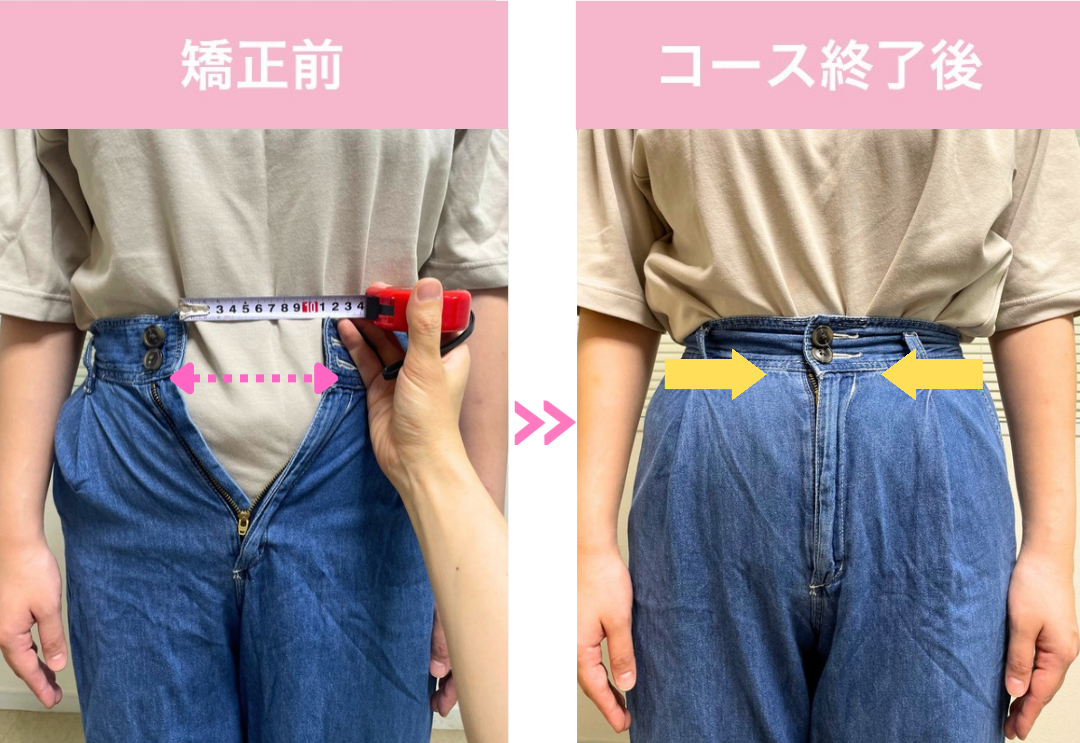 恵比寿クリニーク産後整体院の産後骨盤矯正・ダイエットサポートの施術実例。デニムのウエスト部分を矯正前と5回コース終了後で比較した写真。